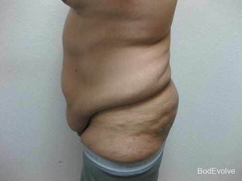 Patient 3 - Cosmetic Surgery After Massive Weight Loss - Before 3