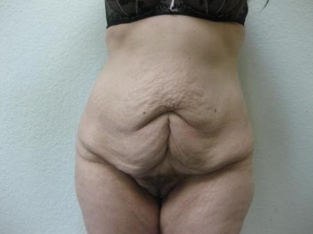 Body Lift - Patient 8 - Before Image 6