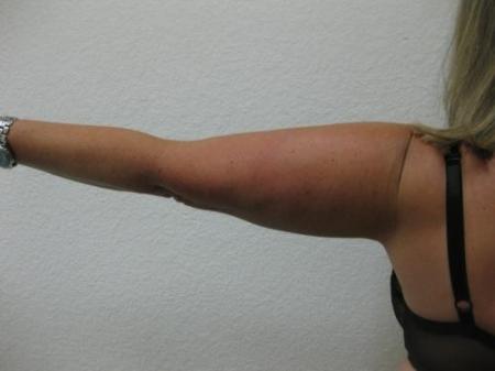 Liposuction - Patient 4 - After Image 4