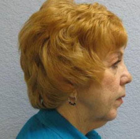 Facelift - Patient 1 - After Image 5