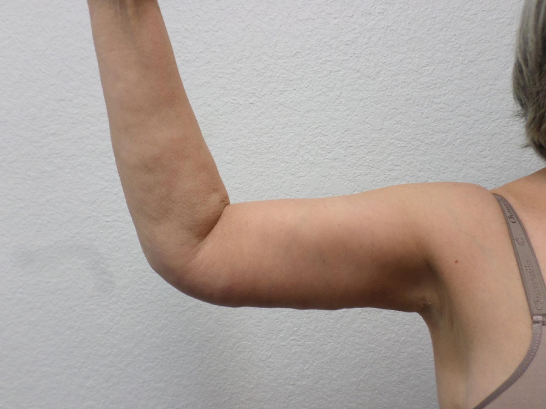 Arm Lift: Patient 9 - After 3