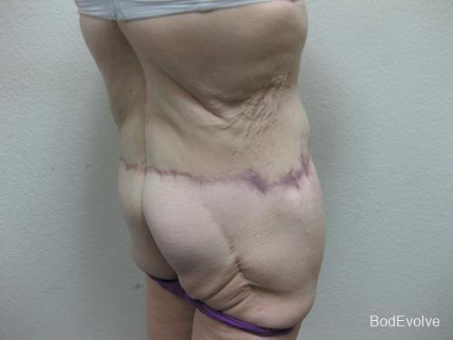 Patient 6 - Cosmetic Surgery After Massive Weight Loss -  After 7