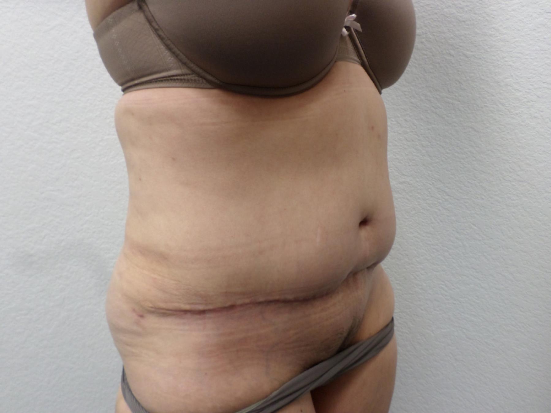 Tummy Tuck: Patient 29 - After 4