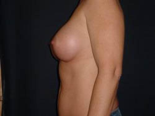 Breast Augmentation - Patient 16 -  After 3