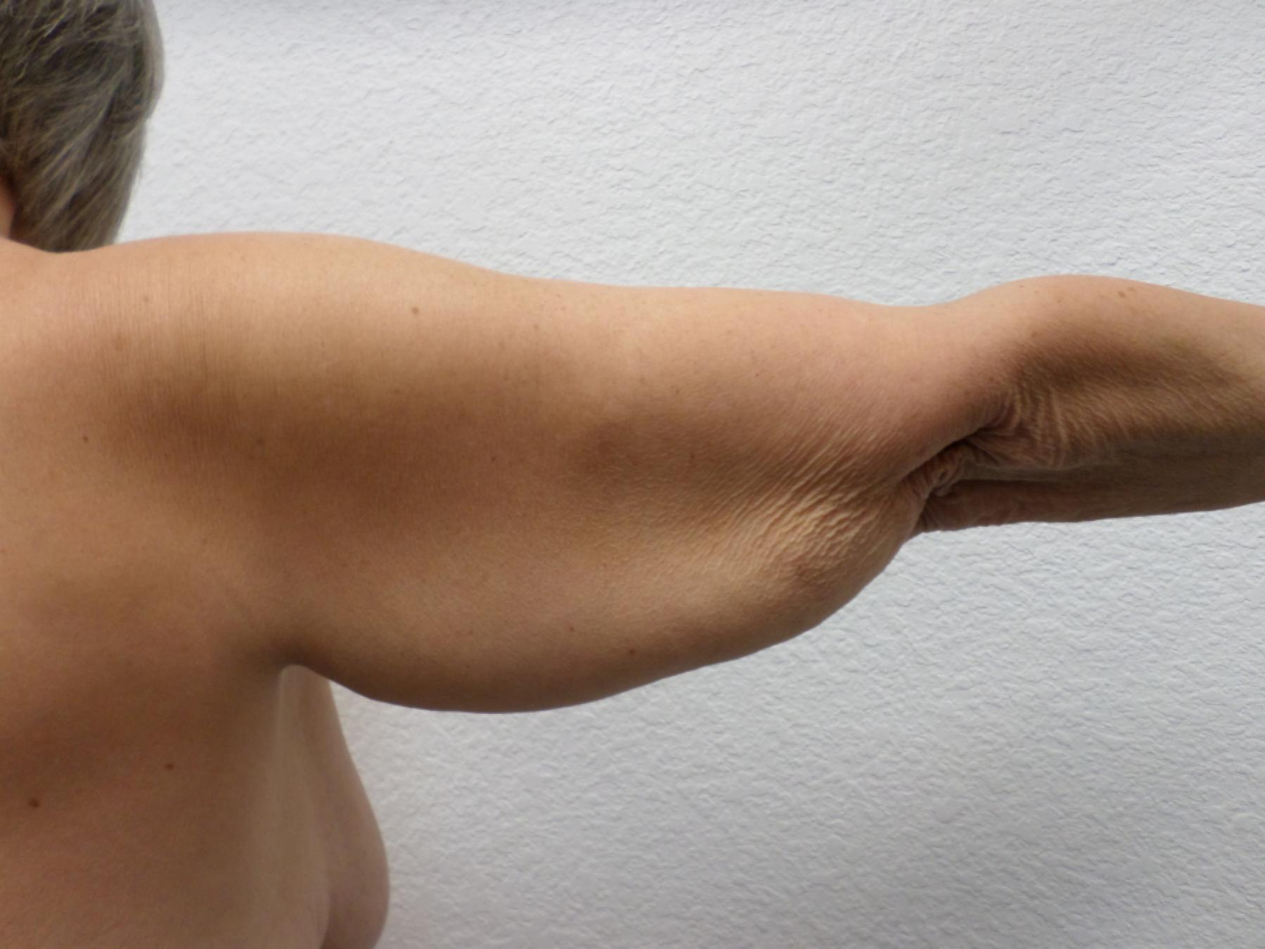 Arm Lift: Patient 9 - Before 7