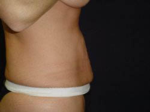Tummy Tuck - Patient 7 - Before and After 3