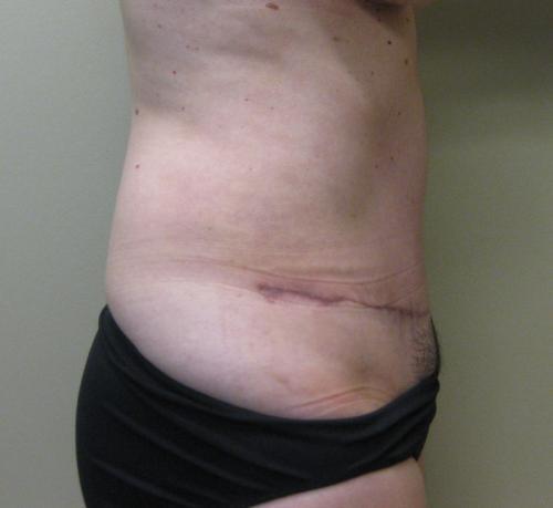 Tummy Tuck - Patient 6 -  After 4
