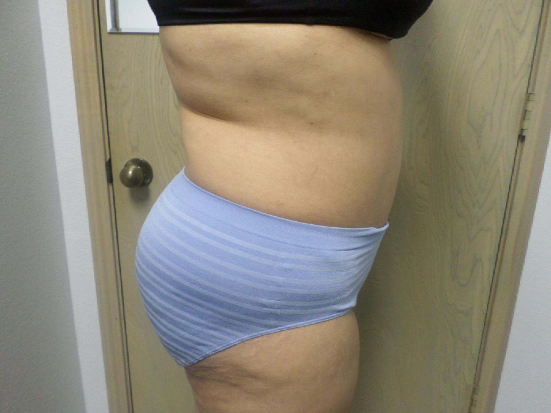 Liposuction: Patient 16 - After 5