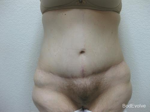 Patient 4 - Cosmetic Surgery After Massive Weight Loss -  After 1