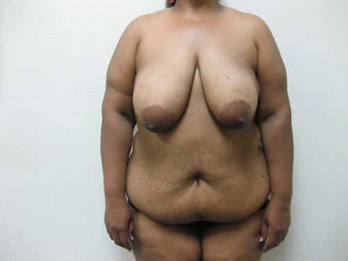 Breast Reduction - Patient 6 - Before 1