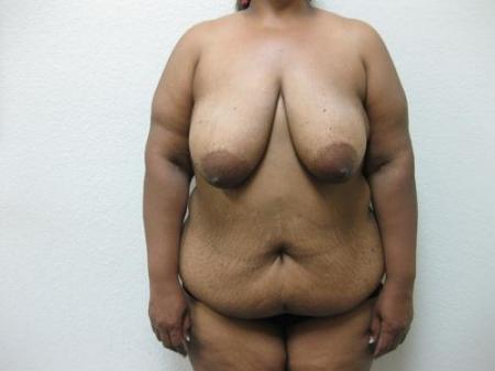 Breast Reduction - Patient 6 - Before