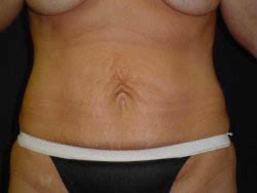 Tummy Tuck - Patient 7 - Before