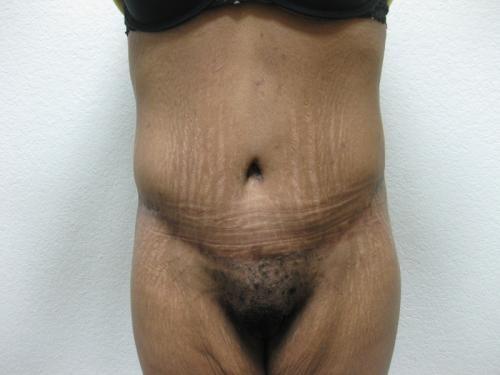 Body Lift - Patient 6 - After 1