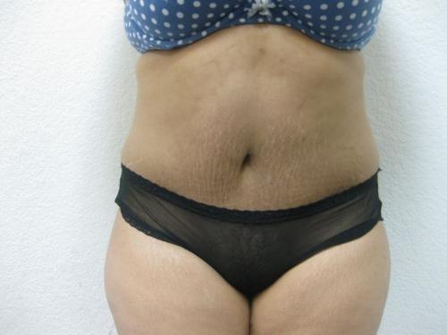 Tummy Tuck - Patient 14 -  After 1