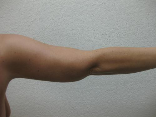 Arm Lift Surgery - Patient 1 -  After 2