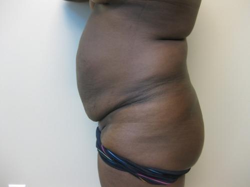 Tummy Tuck - Patient 5 - Before 3