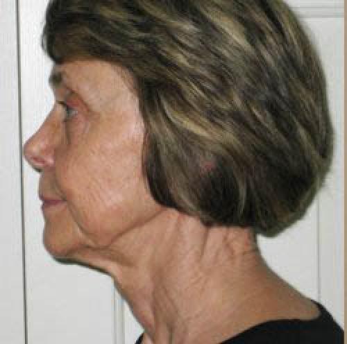 Facelift - Patient 2 - Before
