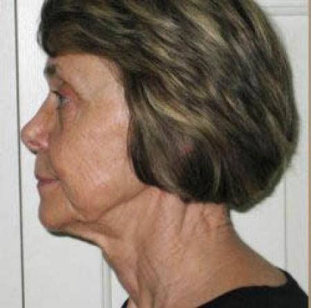 Facelift - Patient 2 - Before Image 1