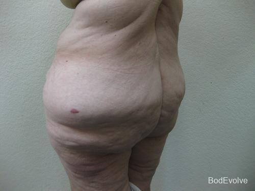 Patient 7 - Cosmetic Surgery After Massive Weight Loss - Before 4