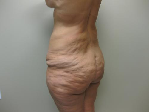 Patient 25 - Cosmetic Surgery After Massive Weight Loss - Before 4