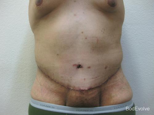 Patient 3 - Cosmetic Surgery After Massive Weight Loss -  After 1