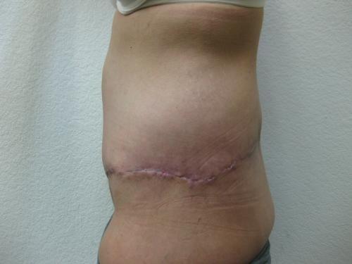 Patient 25 - Cosmetic Surgery After Massive Weight Loss -  After 3
