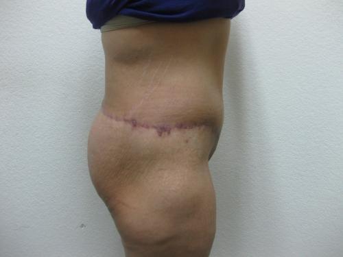 Patient 14 - Cosmetic Surgery After Massive Weight Loss -  After 2