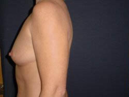 Breast Augmentation - Patient 16 - Before and After 3