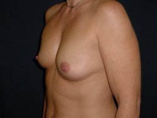 Breast Augmentation - Patient 16 - Before 2
