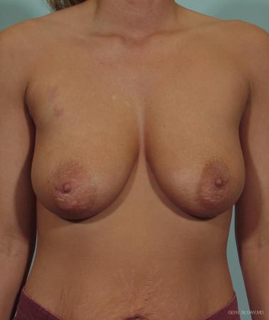 Breast Lift: Patient 5 - Before Image 1