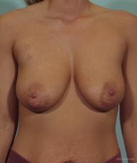 Breast Lift: Patient 5 - Before Image
