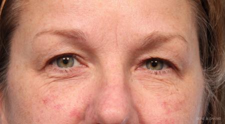Blepharoplasty: Patient 6 - Before Image 1