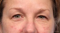 Blepharoplasty: Patient 6 - Before Image