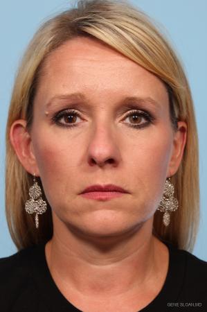 Rhinoplasty: Patient 3 - Before Image 1