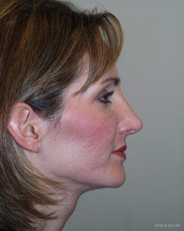 Rhinoplasty: Patient 1 - After Image 2