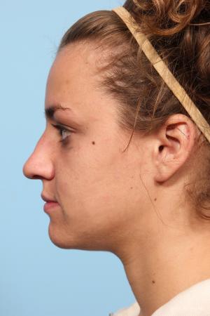 Rhinoplasty: Patient 9 - Before and After Image 2