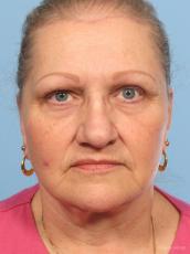 Facelift: Patient 6 - After Image