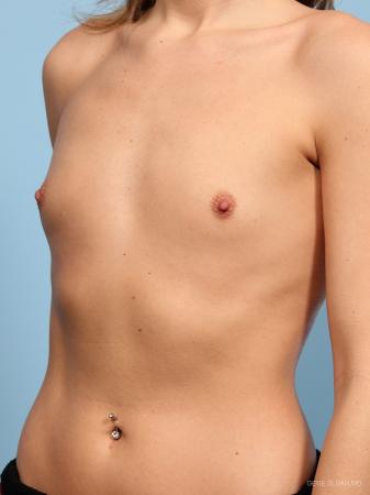 Breast Augmentation: Patient 15 - Before and After Image 2