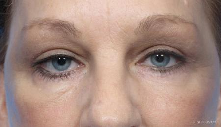 Blepharoplasty: Patient 7 - After Image 1