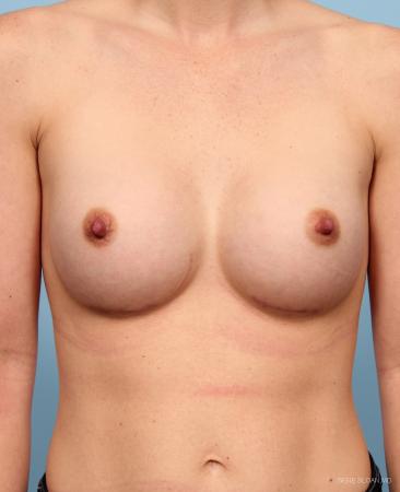 Breast Augmentation: Patient 20 - After Image 1