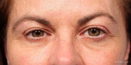 Blepharoplasty: Patient 4 - After Image 1