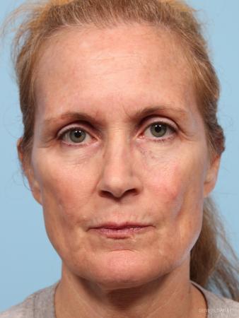 Facelift: Patient 7 - Before Image 1
