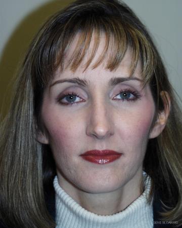 Rhinoplasty: Patient 1 - Before Image 1