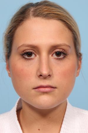 Rhinoplasty: Patient 6 - After Image 1
