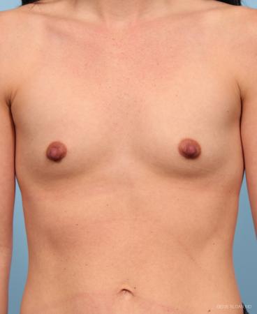 Breast Augmentation: Patient 20 - Before Image 1