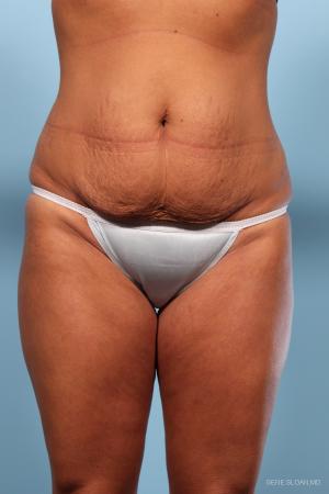 Abdominoplasty: Patient 1 - Before Image 1