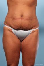 Abdominoplasty: Patient 1 - Before Image