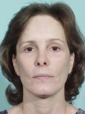 Facelift: Patient 5 - After Image