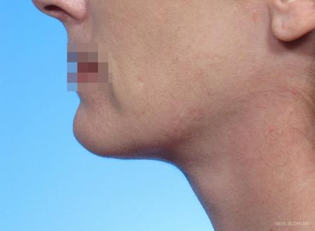 Neck Lift: Patient 2 - After Image 1