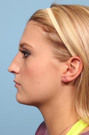 Rhinoplasty: Patient 6 - Before and After Image 2